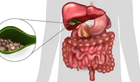 Dolor abdominal continuo, ictericia, orina oscura y otros síntomas que pueden indicar cálculos biliares