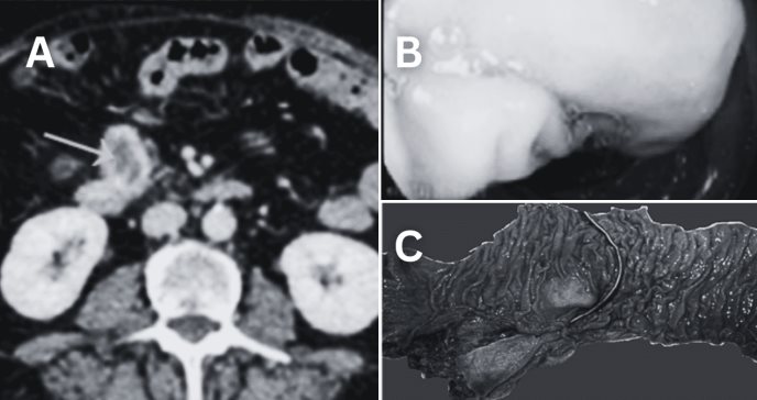 Paciente femenina presentó síndrome carcinoide por tumor del estroma gastrointestinal duodenal