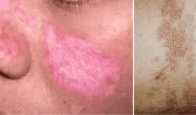 Valaciclovir es eficaz en la prevención del herpes zóster en pacientes con lupus tratados con anifrolumab