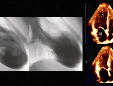 Síndrome de Takotsubo: Infarto miocardio por estrés emocional en mujer con hipertensión e hipotiroidismo