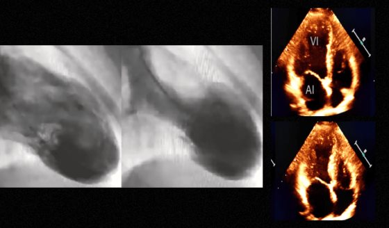 Síndrome de Takotsubo: Infarto miocardio por estrés emocional en mujer con hipertensión e hipotiroidismo