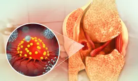 Cáncer óseo en niños: descubren cómo el caos genético impulsa el avance del osteosarcoma