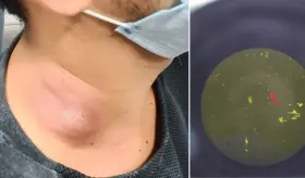 Inflamación prolongada en el cuello revela diagnóstico de tuberculosis extrapulmonar en hombre de 26 años