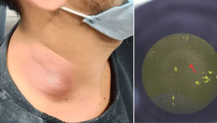 Inflamación prolongada en el cuello revela diagnóstico de tuberculosis extrapulmonar en hombre de 26 años