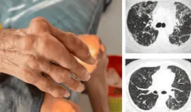 Humo de incendios forestales estaría aumentando el riesgo de artritis reumatoide y enfermedad pulmonar