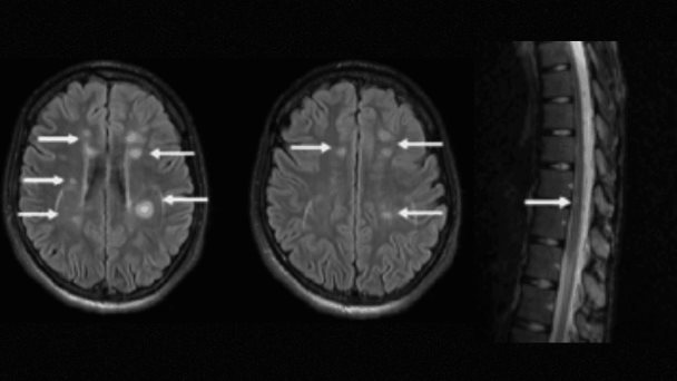 Migraña persistente y debilidad en el lado izquierdo del cuerpo:Diagnóstico tardío de Esclerosis Múltiple Migraña persistente y debilidad en el lado izquierdo del cuerpo:Diagnóstico tardío de Esclerosis Múltiple