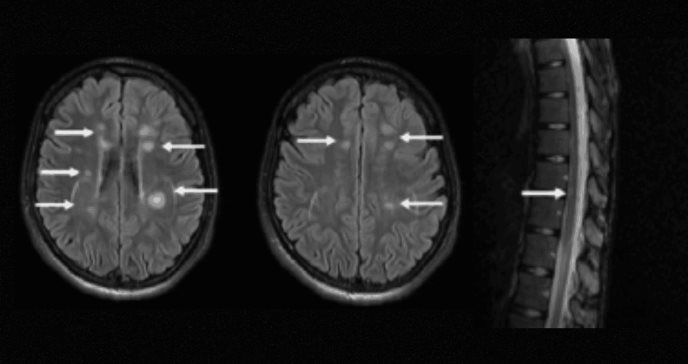 Migraña persistente y debilidad en el lado izquierdo del cuerpo:Diagnóstico tardío de Esclerosis Múltiple