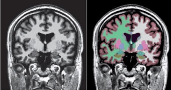 Niño de 8 años con letargia e inestabilidad emocional es diagnosticado con hipersomnolencia transitoria