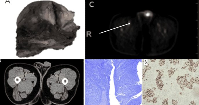 Paciente con dolor y abultamiento en la zona del pene es diagnosticado con carcinoma tipo linfoepitelioma