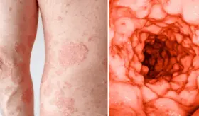 La Psoriasis estaría relacionada con aparición de enfermedades intestinales inflamatorias como el Crohn 