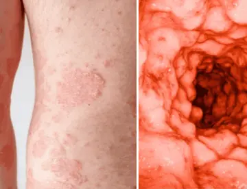 La Psoriasis estaría relacionada con aparición de enfermedades intestinales inflamatorias como el Crohn 
