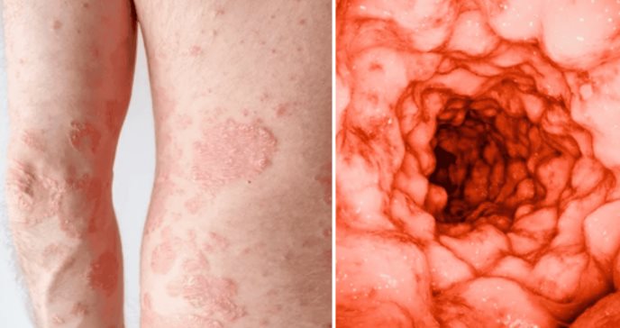 La Psoriasis estaría relacionada con aparición de enfermedades intestinales inflamatorias como el Crohn 