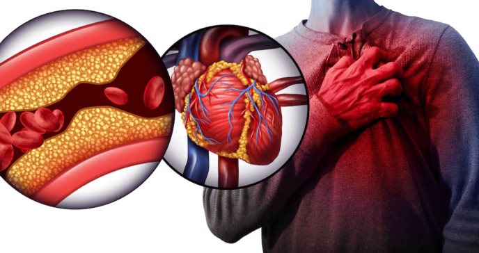 Desarrollan modelo que podría predecir el trombo ventricular izquierdo tras un infarto agudo de miocardio