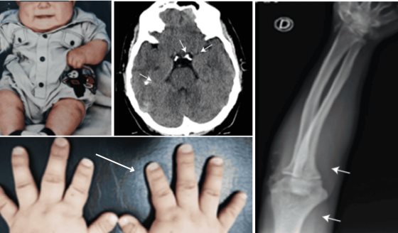 Diagnóstico de pseudohipoparatiroidismo en joven de 18 años con hipotiroidismo, obesidad y osteoporosis 