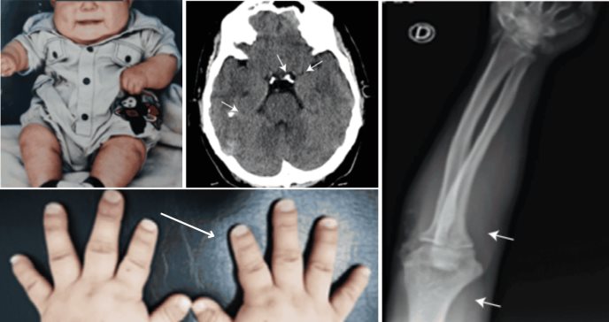 Diagnóstico de pseudohipoparatiroidismo en joven de 18 años con hipotiroidismo, obesidad y osteoporosis 