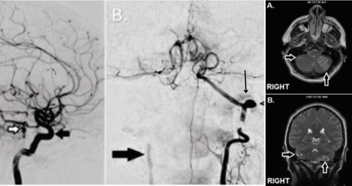 Isquemia vertebrobasilar se manifiesta con cefalea, vértigo y parálisis facial en paciente de 41 años