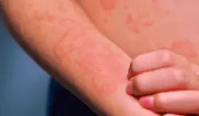 Rascarse: el alivio que empeora la inflamación pero ayuda a combatir infecciones