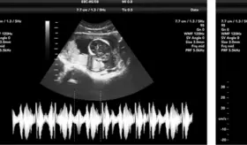 Inteligencia artificial mejora la detección de defectos cardíacos congénitos en ecografías prenatales