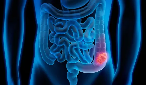 Mini-examen cl&iacute;nico: &iquest;Cu&aacute;nto sabe sobre la colitis ulcerosa?