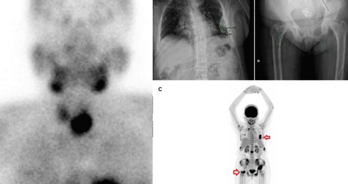 Mujer de 62 años con dolor óseo e hipercalcemia es diagnosticada con hiperparatiroidismo 