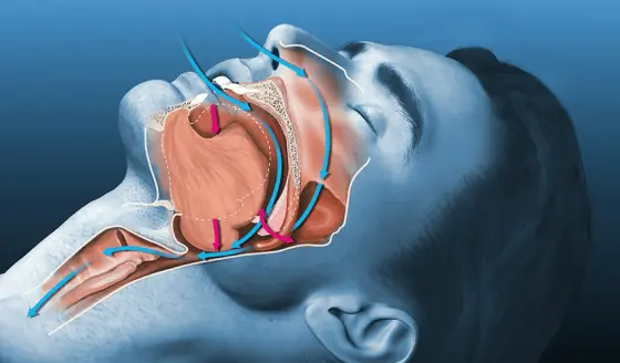 Mini-examen clínico: ¿Puede tratar y controlar la apnea obstructiva del sueño?