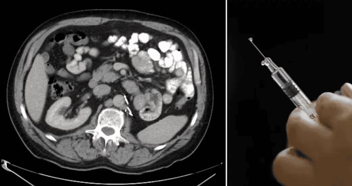 Vacuna experimental previene recaídas en cáncer de riñón: Pacientes libres de cáncer tres años después