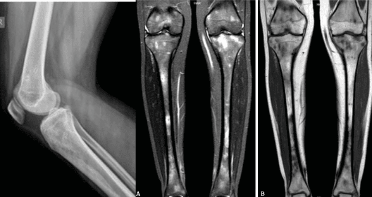 Osteomielitis crónica se manifiesta con pérdida de fuerza muscular y dolor al tragar en joven de 16 años