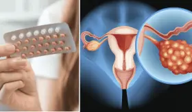 El uso de la píldora anticonceptiva reduciría el riesgo de cáncer de ovario, según un estudio 