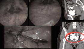 Mujer con DIU migrado a la bolsa vesicouterina: extracción laparoscópica exitosa 