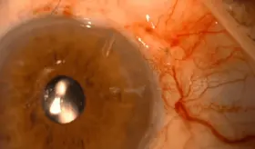 Colesterol "bueno" y glaucoma: Advierten de nuevo factor de riesgo en mayores de 55 a&ntilde;os