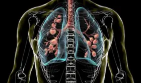 Fibrosis quística: descubren alteraciones inmunitarias desde el nacimiento que agravan la inflamación