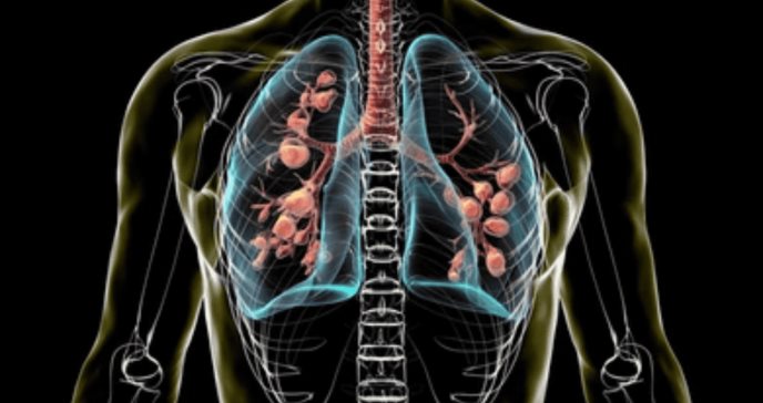 Fibrosis quística: descubren alteraciones inmunitarias desde el nacimiento que agravan la inflamación