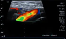Detectan trombosis de la vena espermática en joven de 21 años con dolor testicular y fiebre
