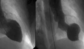 ¿Es posible reparar un corazón roto? conozca los síntomas de la cardiopatía de takotsubo