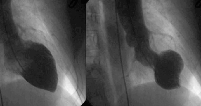 ¿Es posible reparar un corazón roto? conozca los síntomas de la cardiopatía de takotsubo