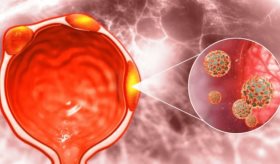 Talazoparib y enzalutamida mejoran la supervivencia en cáncer de próstata resistente a la castración  
