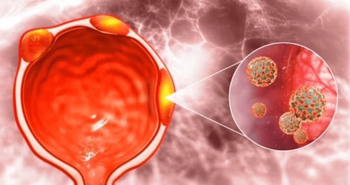 Talazoparib y enzalutamida mejoran la supervivencia en cáncer de próstata resistente a la castración  