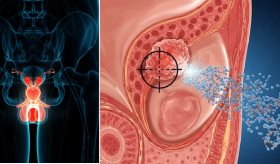 Desarrollan nanopartículas orgánicas que alcanzan tumores de próstata y liberan el fármaco con precisión
