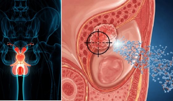 Desarrollan nanopartículas orgánicas que alcanzan tumores de próstata y liberan el fármaco con precisión
