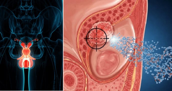 Desarrollan nanopartículas orgánicas que alcanzan tumores de próstata y liberan el fármaco con precisión