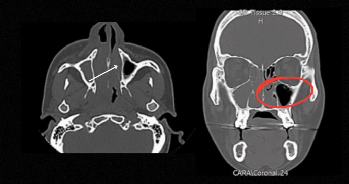 Secreción, hinchazón facial y dolor al tragar: diagnóstico y manejo del linfoma extranodal NK/T nasal