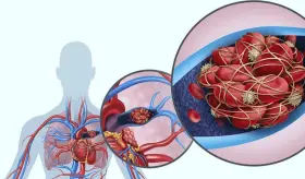 Tromboembolismo pulmonar: Qué es, síntomas, causas, factores de riesgo y tratamiento 
