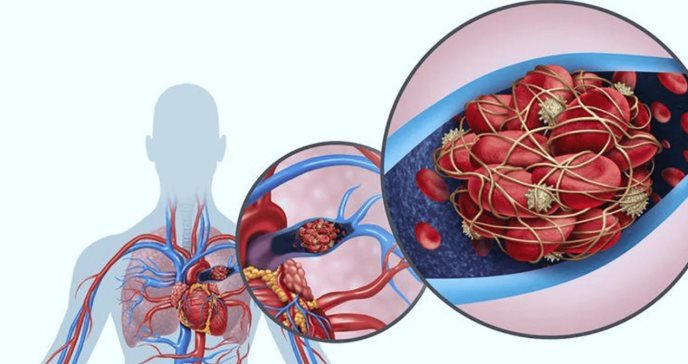 Tromboembolismo pulmonar: Qué es, síntomas, causas, factores de riesgo y tratamiento 