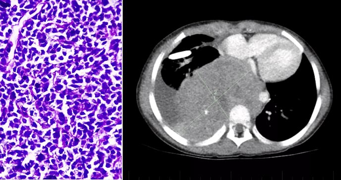 Paciente con neuroblastoma lleva 18 años de remisión tras tratamiento con terapia celular CAR-T