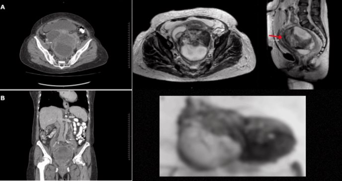 Absceso pélvico, confundido con tumor ovárico, desplaza útero, vejiga y recto en mujer posmenopáusica