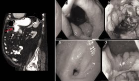 Colonoscopia para resección de pólipo con asa caliente ocasiona fístulas gastrocólicas en paciente