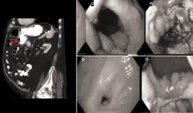 Colonoscopia para resección de pólipo con asa caliente ocasiona fístulas gastrocólicas en paciente