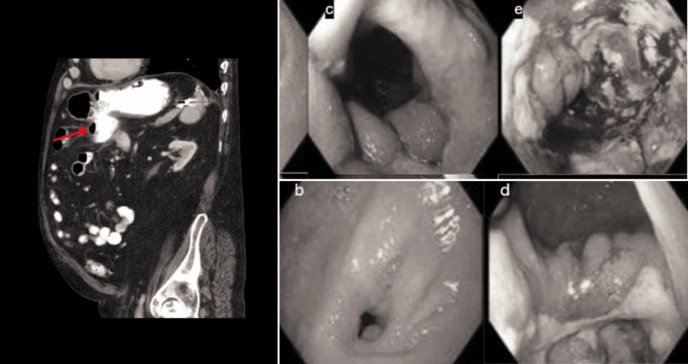 Colonoscopia para resección de pólipo con asa caliente ocasiona fístulas gastrocólicas en paciente