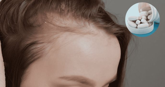 Minoxidil oral en dosis bajas mejora la alopecia frontal fibrosante