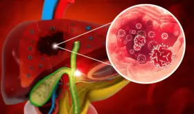 Hígado graso asociado a disfunción metabólica: Riesgo de cirrosis y enfermedad cardiovascular